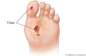 Diabetic Foot Ulcer is a Chronic Wound