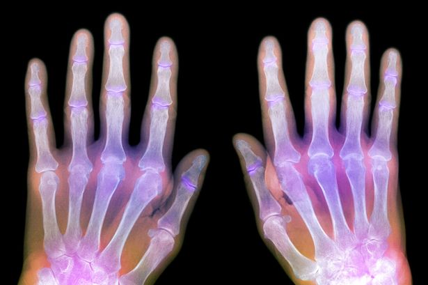 Living "Young" Despite Rheumatoid Arthritis - Patricia's Story