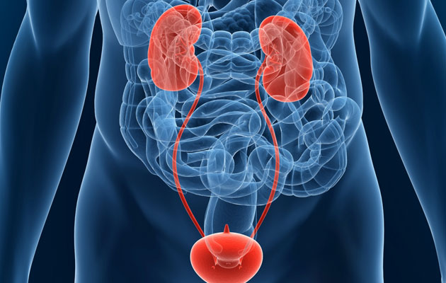 Can intermittent catheter use increase the risk of bladder cancer?