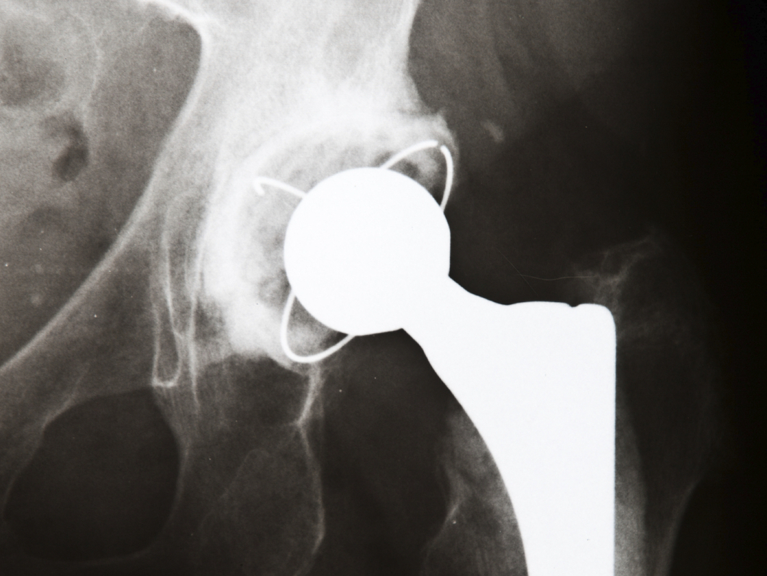 Best and the Worst Hospitals for Joint Replacement