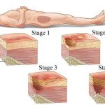 Pressure Ulcer Stages