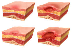 Dangers of Pressure Ulcers, Pressure Sores, or Decubitus Ulcers 