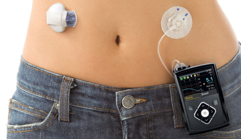 Medtronic MiniMed 670G Automatic Insulin Pump Gets FDA Approval