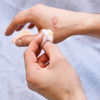 Treating a Burn with Wound Care Products